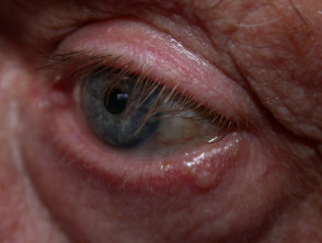 Basal Cell Carcinoma Affecting The Eyelid Images Dermnet Nz