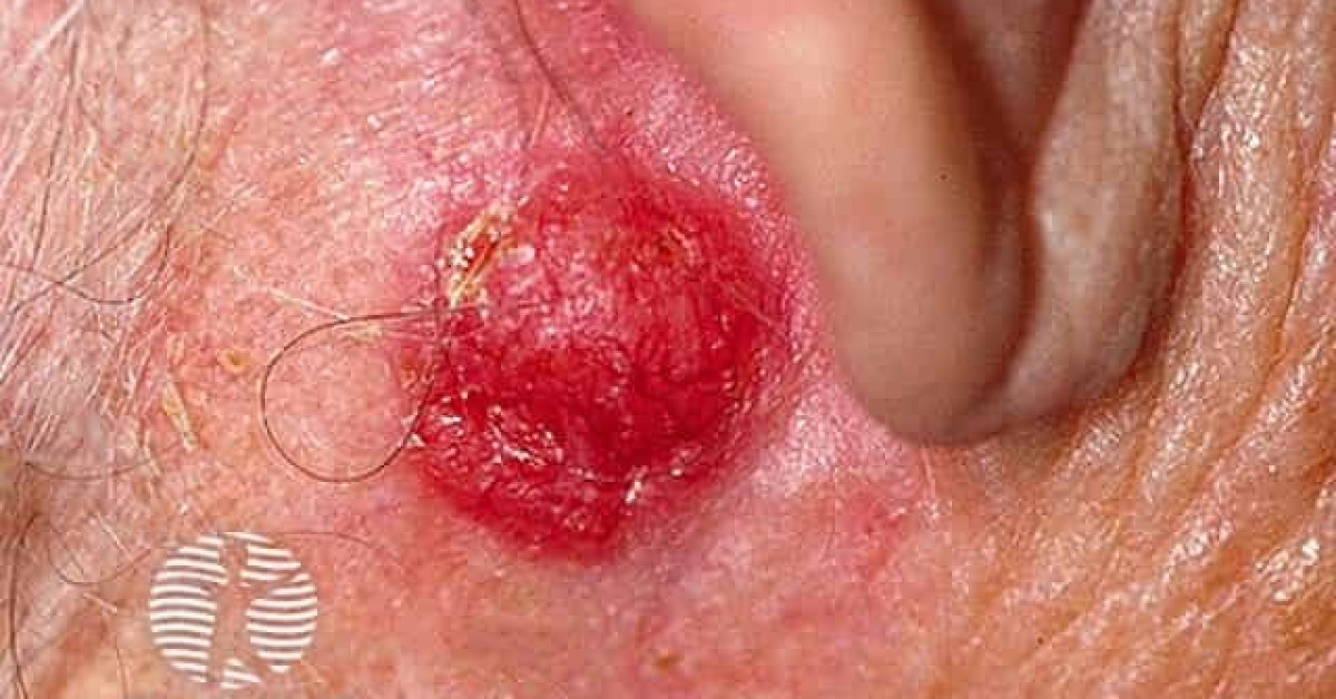 Basal Cell Carcinoma Affecting The Face Image 7965