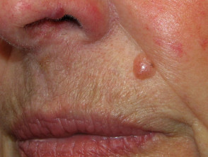 Basal Cell Carcinoma Affecting The Face Images Dermnet Nz