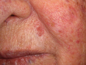 Basal cell carcinoma affecting the face images | DermNet