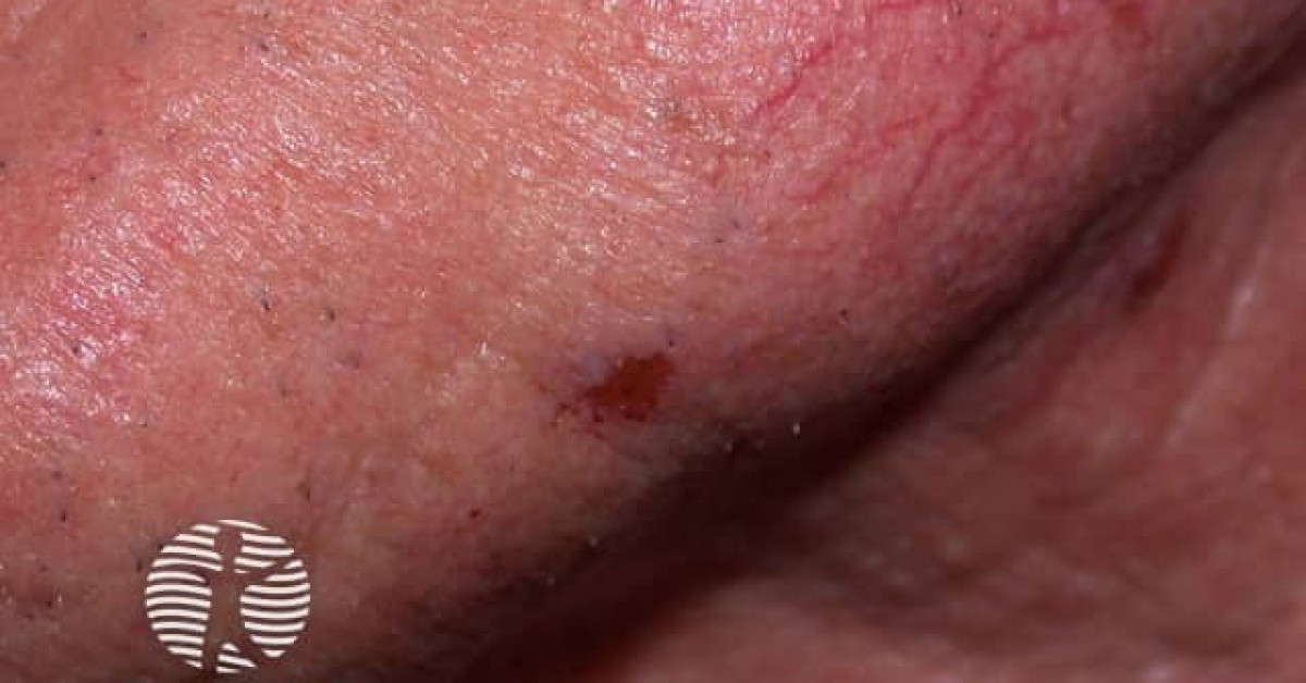 Dermnet® Basal Cell Carcinoma Affecting The Face Image 8361