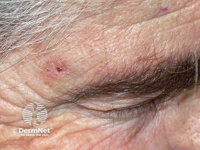Basal cell carcinoma affecting the face