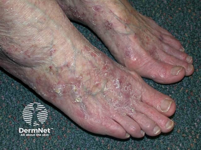 Actinic Keratoses affecting the legs and feet