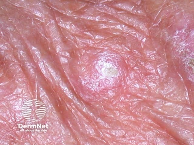 A rough scaly lesion on the back of the hand - a common site for an actinic keratosis