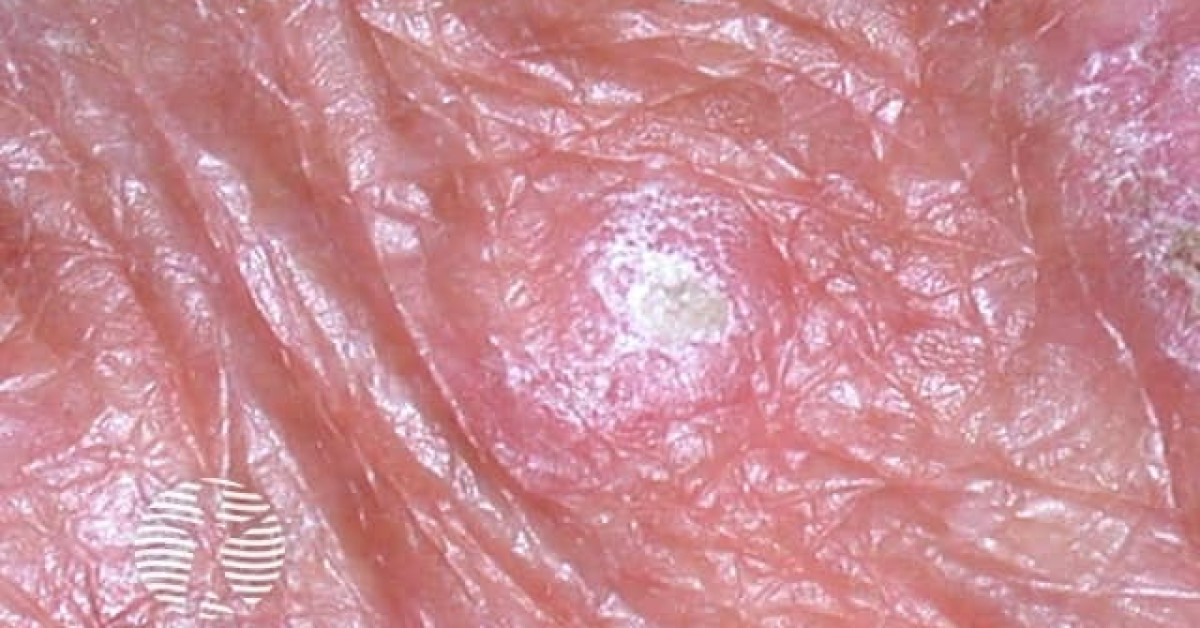 Basal cell carcinoma affecting the arms and legs image