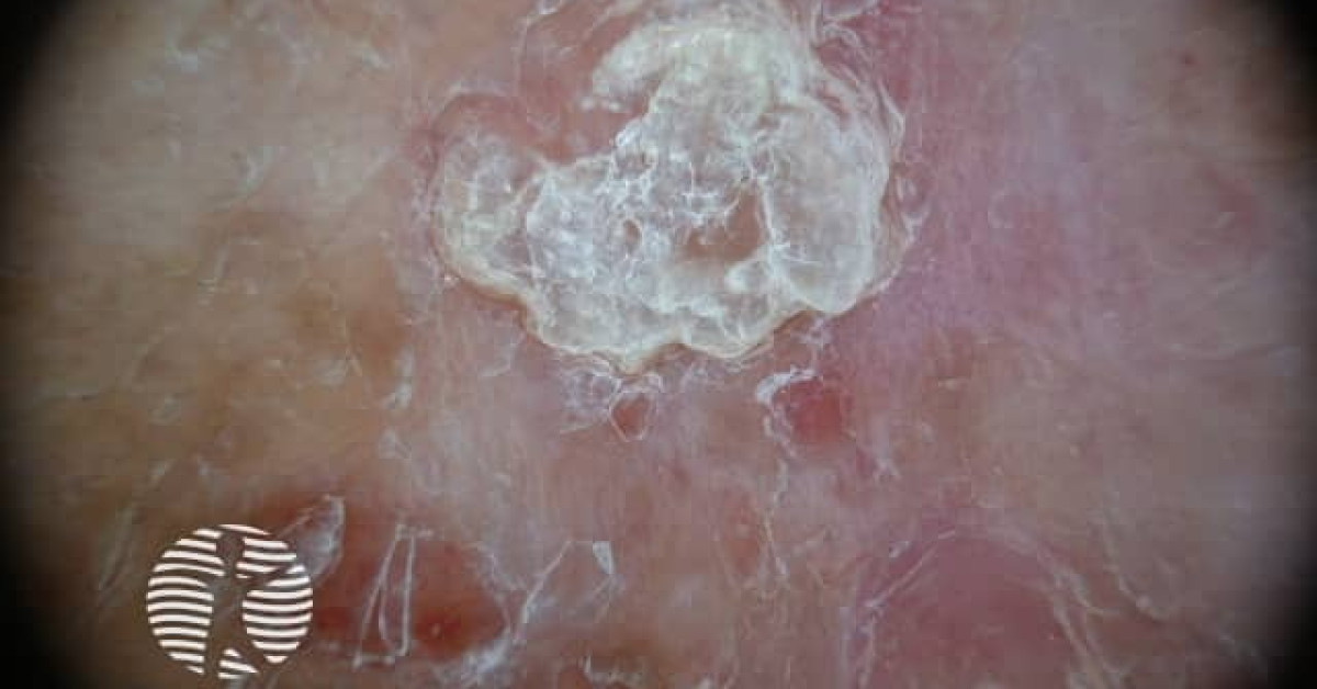 Basal cell carcinoma affecting the arms and legs image