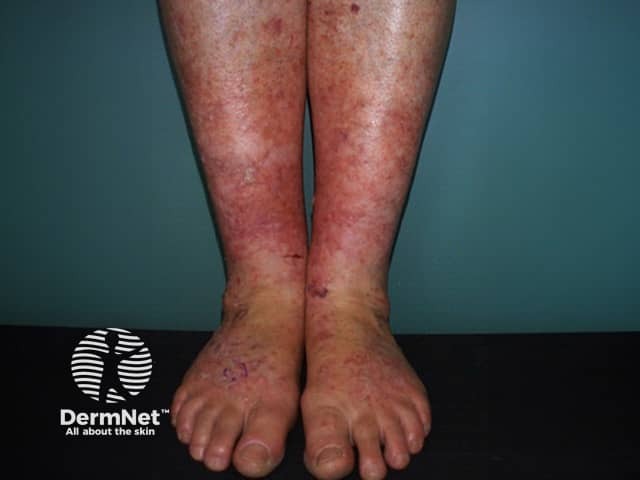 Actinic keratoses affecting the legs and feet