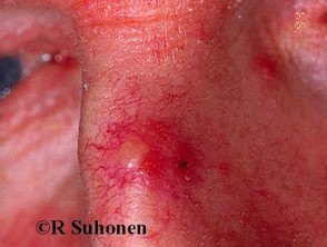 Basal Cell Carcinoma Affecting The Nose Images Dermnet Nz