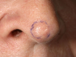early basal cell carcinoma nose