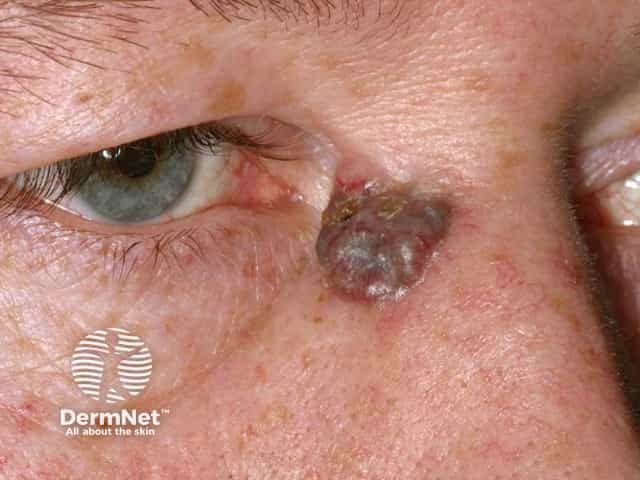 Basal cell carcinoma affecting the nose