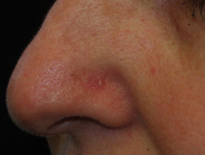 Basal Cell Carcinoma Affecting The Nose Images Dermnet Nz