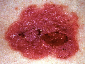 Basal cell carcinoma