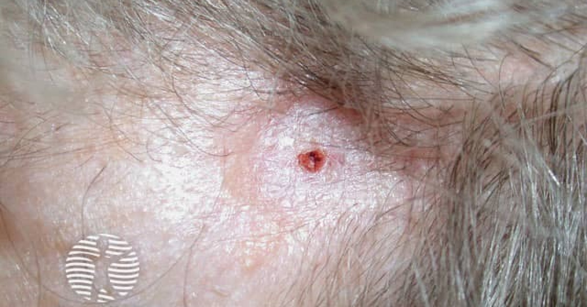 Dermnet® Morphoeic Basal Cell Carcinoma Image