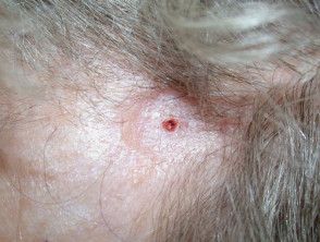 Morphoeic basal cell carcinoma