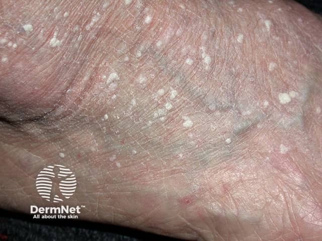Florid lesions of stucco keratoses on the ankle