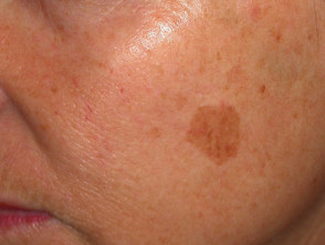 Freckle before cryotherapy