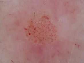 Clear cell acanthoma dermoscopy