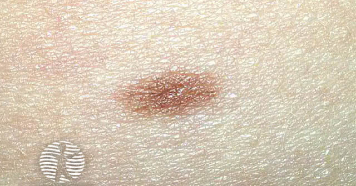 common-mole-image