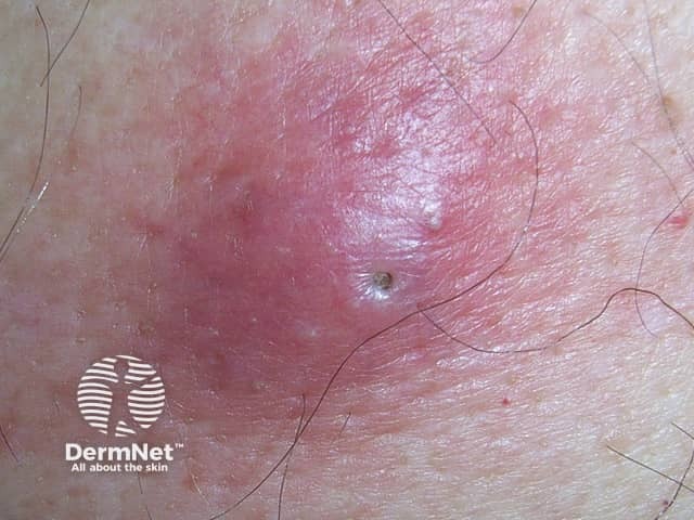An inflamed cyst accentuating the punctum