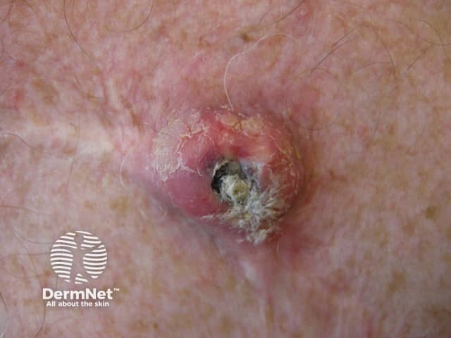 A recurrent epidermoid cyst  - note the scar from a previous incomplete excision