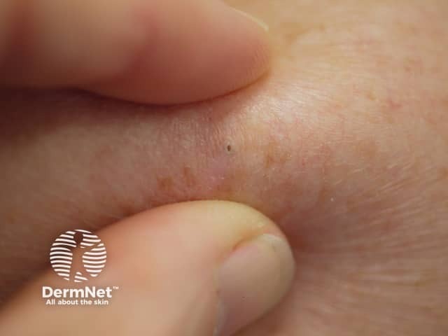 Palpating an epidermoid cyst