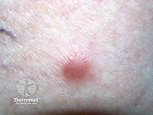 Dermatofibroma Face Icd 10
