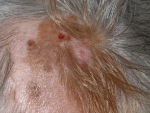 Desmoplastic melanoma arising within lentigo maligna