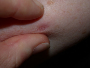 Dermatofibroma pinch sign