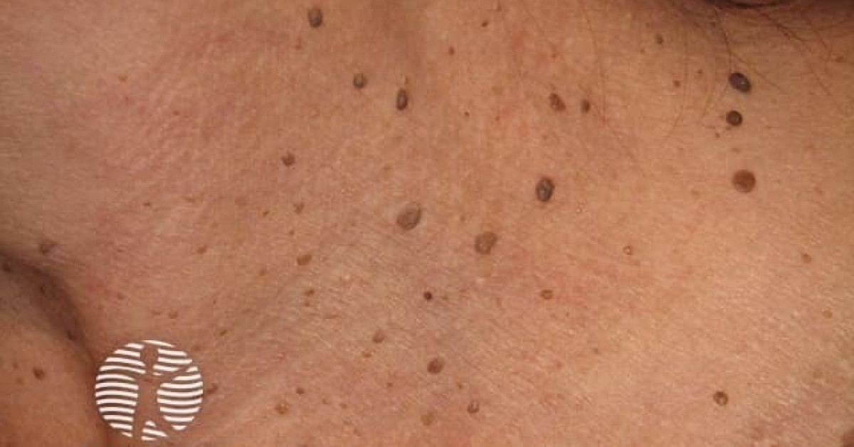 Management Of Dermatosis Papulosa Nigra