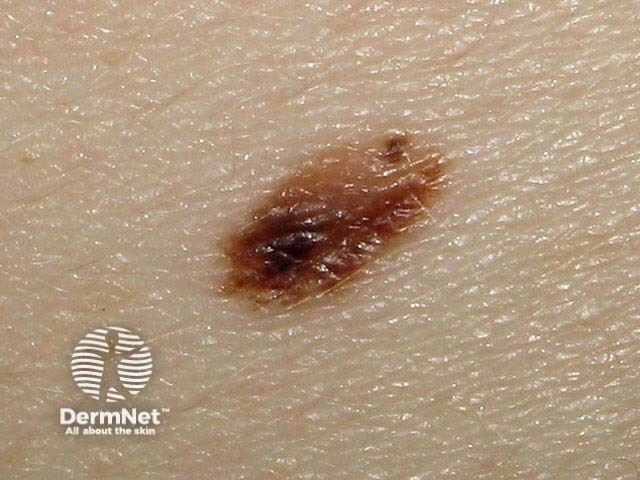 Moles melanocytic Naevi Pigmented Nevi Moles melanocytic Naevi Pigmented Nevi