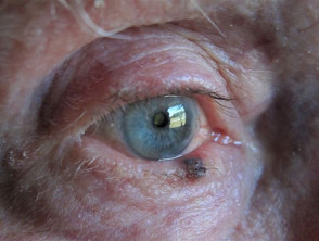 melanoma on eyelid