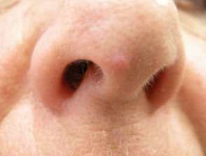 Fibrous papule of the nose