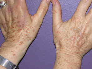 Freckles on hand before and after green laser light
