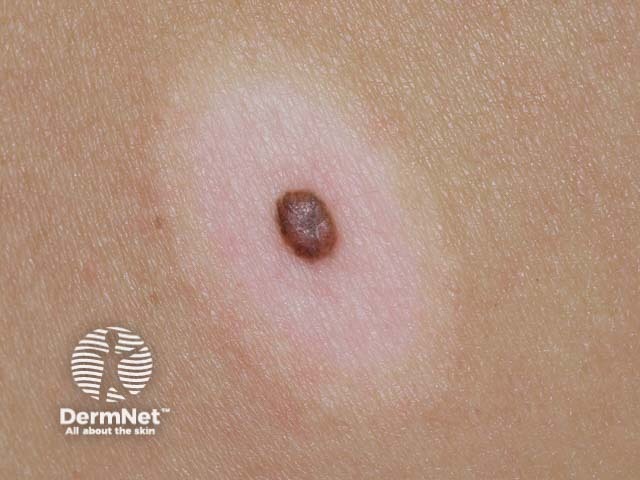Junctional Nevus Vs Compound Nevus Junctional Nevus Vs Compound Nevus