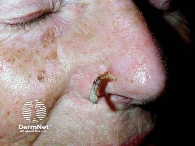Cutaneous Horn Treatment