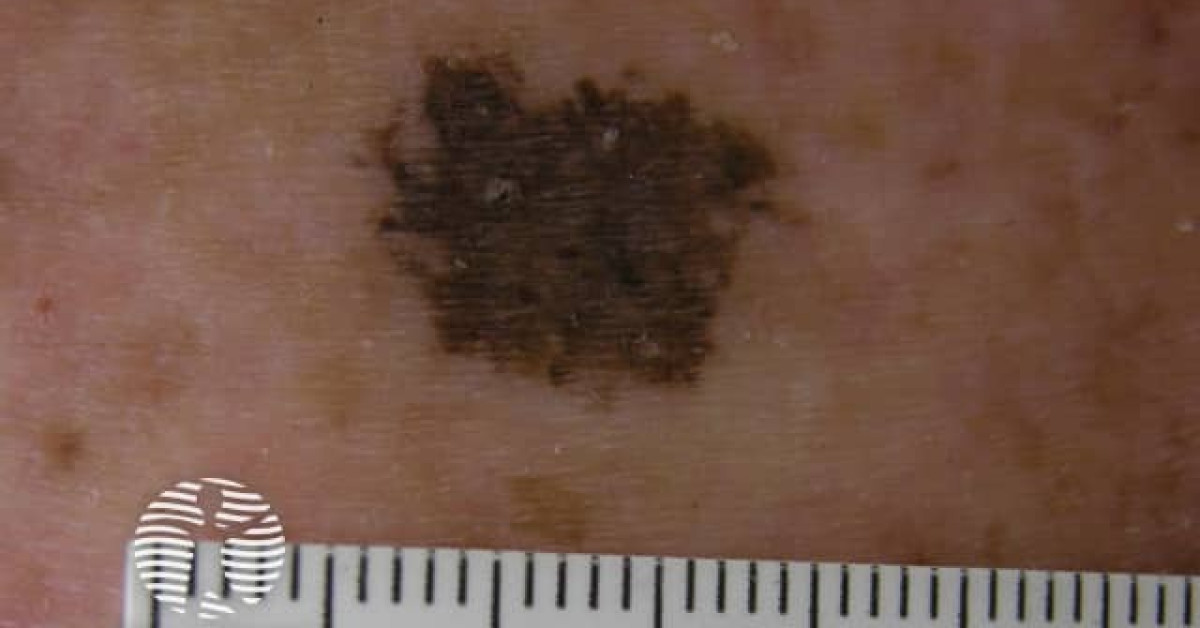 Ink Spot Example Ink spot lentigo image