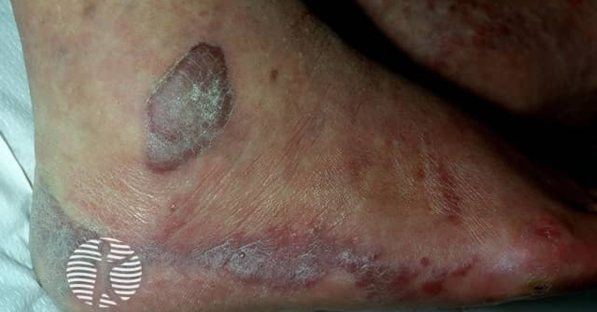 Kaposi Sarcoma Image