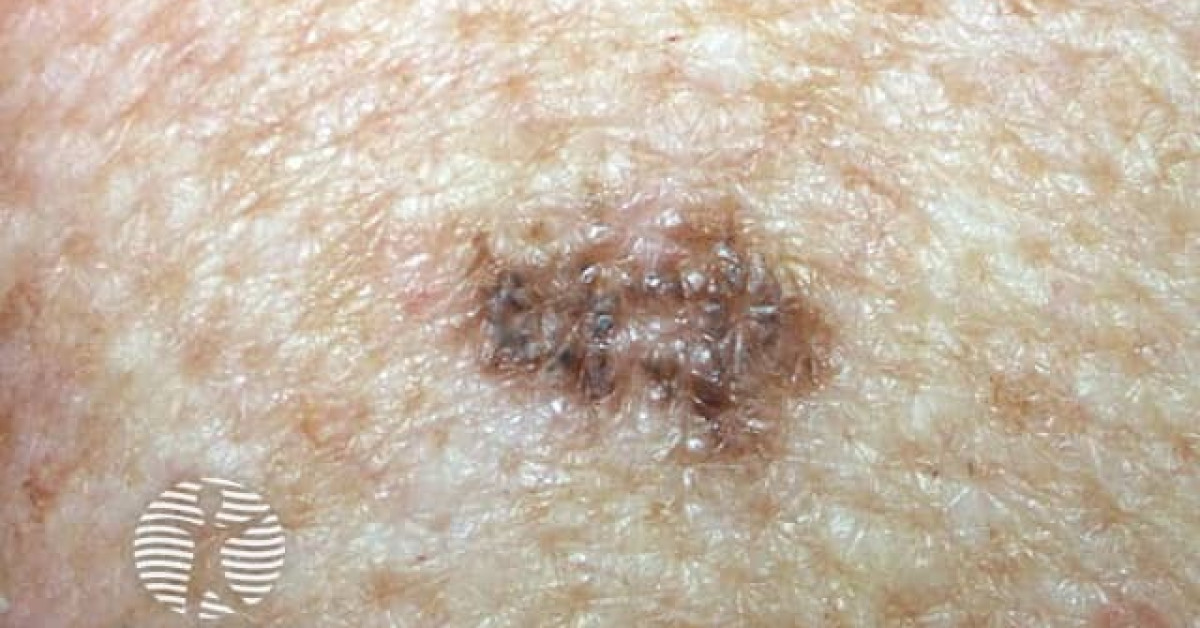 DermNet® - Lentiginous melanoma image