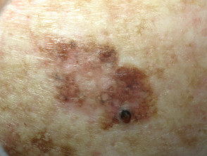 Lentiginous melanoma