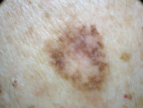 Lentiginous melanoma
