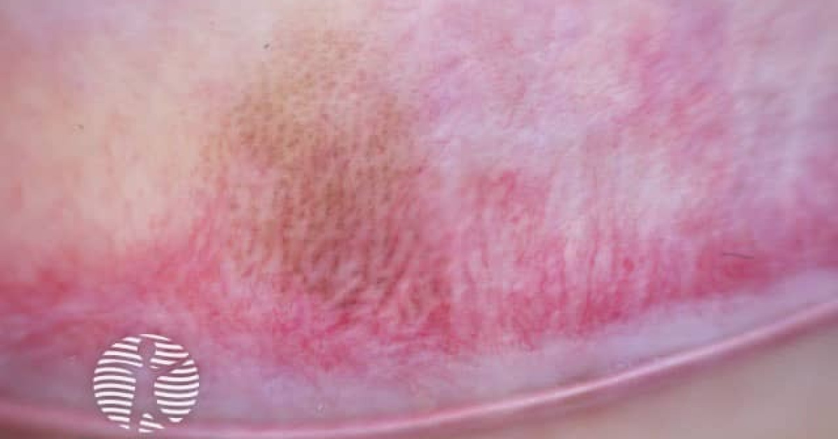 labial melanotic macule dermoscopy PDF) of venous lake on the lips: A comparative study with Labial melanotic macule (brown spot