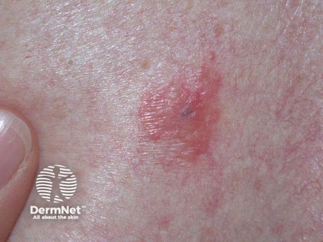 Amelanotic melanoma