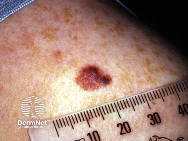 Superficial spreading melanoma in 14-year-old