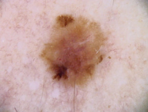 Superficial spreading melanoma dermoscopy in teenager