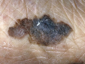 Acral lentignous melanoma