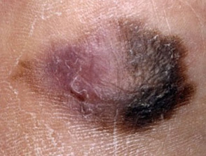 Acral lentignous melanoma