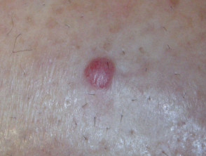 Melanoma like does a what look Skin cancer