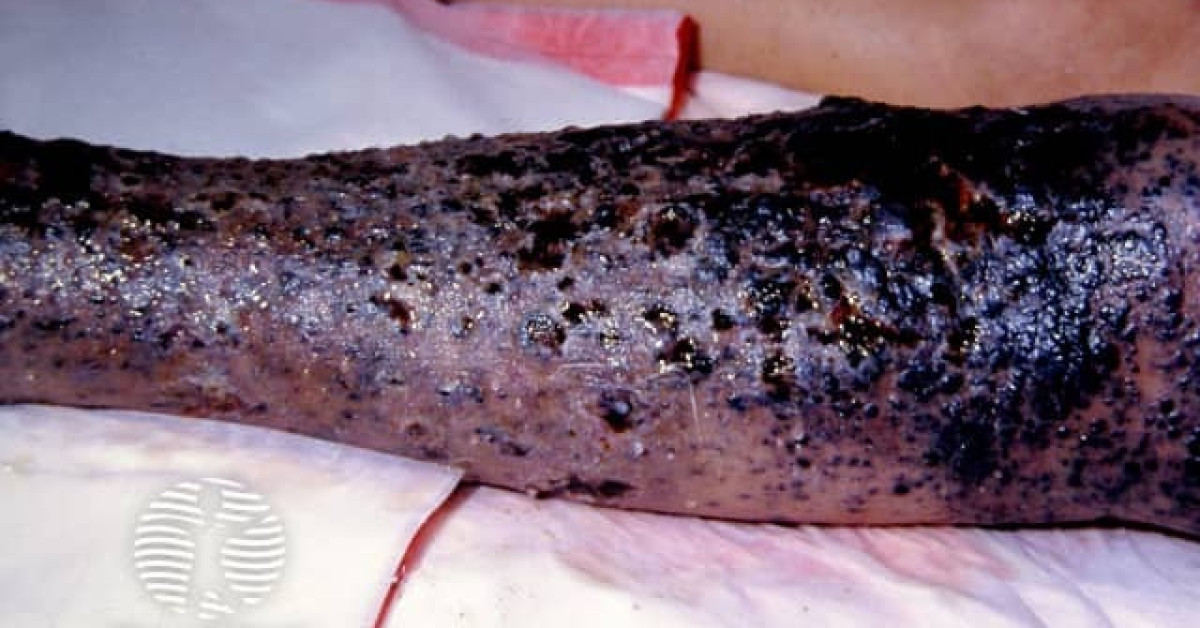 metastatic melanotic sarcoma A para-aortic malignant melanotic nerve sheath tumor mimicking a gastrointestinal stromal tumor: a rare case report and Melanotic sarcoma | definition of