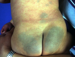 Lumbosacral dermal melanocytosis. Mongolian spot