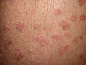 Squmaous cell papilloma or viral wart